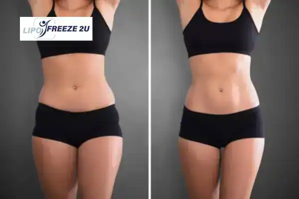 How Can LIPO FREEZE 2U Support Your Post-Pregnancy Body Recovery Chelmsford?