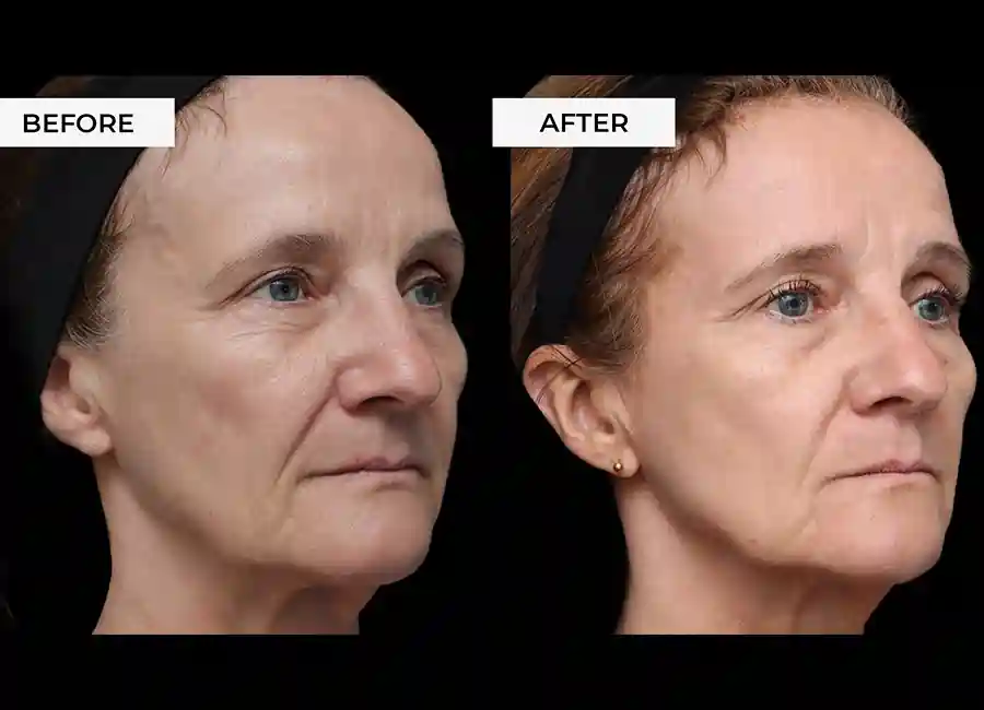 How Many RF Microneedling Sessions Will You Need to See a Difference Chelmsford?