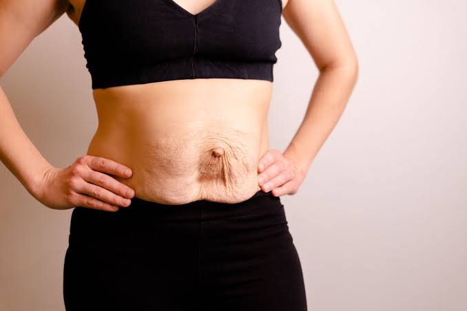 Is Surgery Really the Only Way to Repair Diastasis Recti Chelmsford?