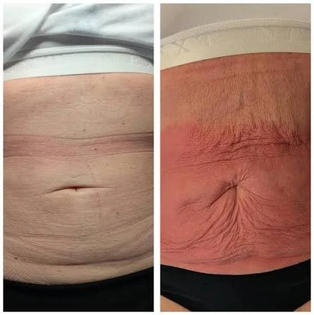 How Does RF Microneedling Improve Crepey, Thin and Uneven Skin Texture Chelmsford?